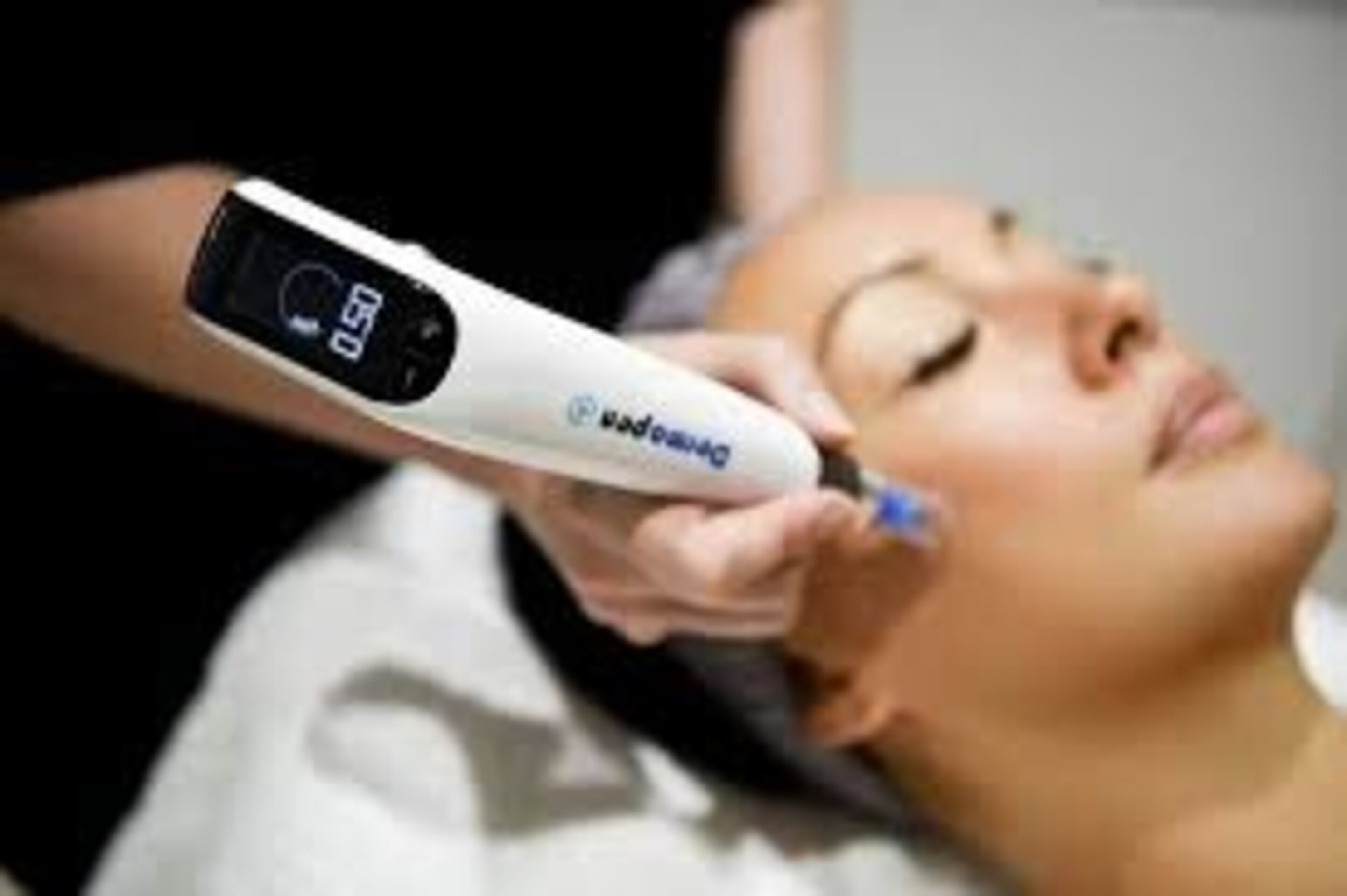 SESIÓN FACIAL CON DERMAPEN - 2